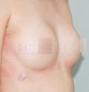 微整形隆胸术前后对比照片