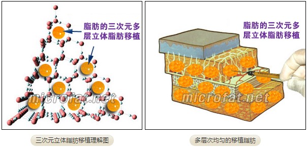 3D脂肪移植