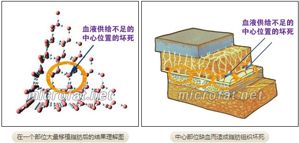 在一个部位进行大量脂肪移植的结果