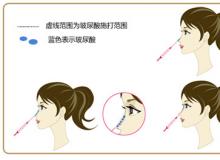 玻尿酸注射隆鼻成效 价格是多少