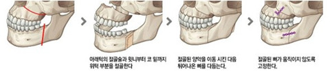 韩国DA医院双鄂手术价格是多少