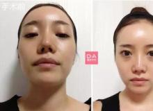 韩国DA整形对比图【颜面轮廓+脂肪移植】整形案例