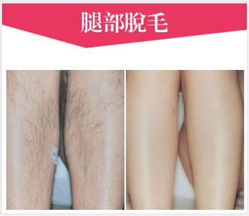 冰点激光脱腿毛对比图