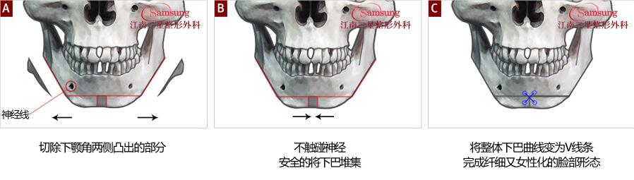 立体V-line四颌角缩小术