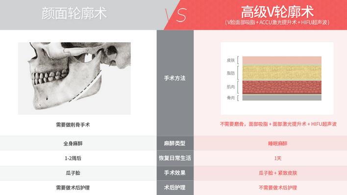 高级V轮廓术