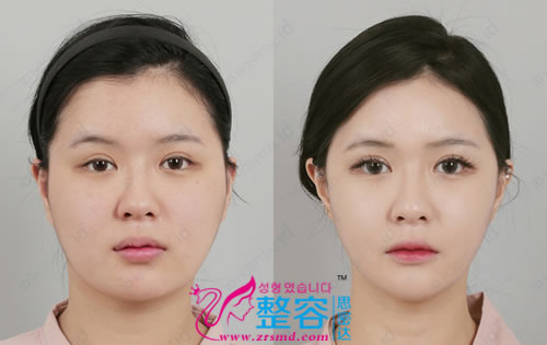 Vline下颌角手术+ 脸部脂肪溶脂手术前后对比案例