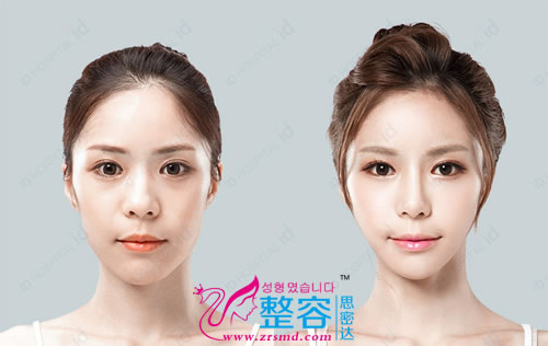 Vline下颌角手术+鼻综合手术对比日记