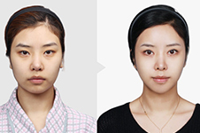 韩国TL整形医院做鼻整形手术怎么样？