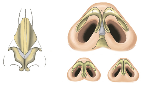 鼻尖低平手术改善方式示意图