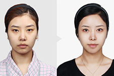 韩国做鼻头缩小整形手术哪家医院好？