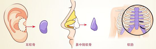 自体耳软骨隆鼻