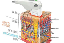 韩国超声刀除皱效果好吗？